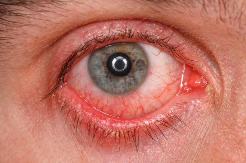 Conjunctivitis Treatment That You Need To Know - The Kitchensurvival