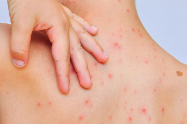 shingles treatment