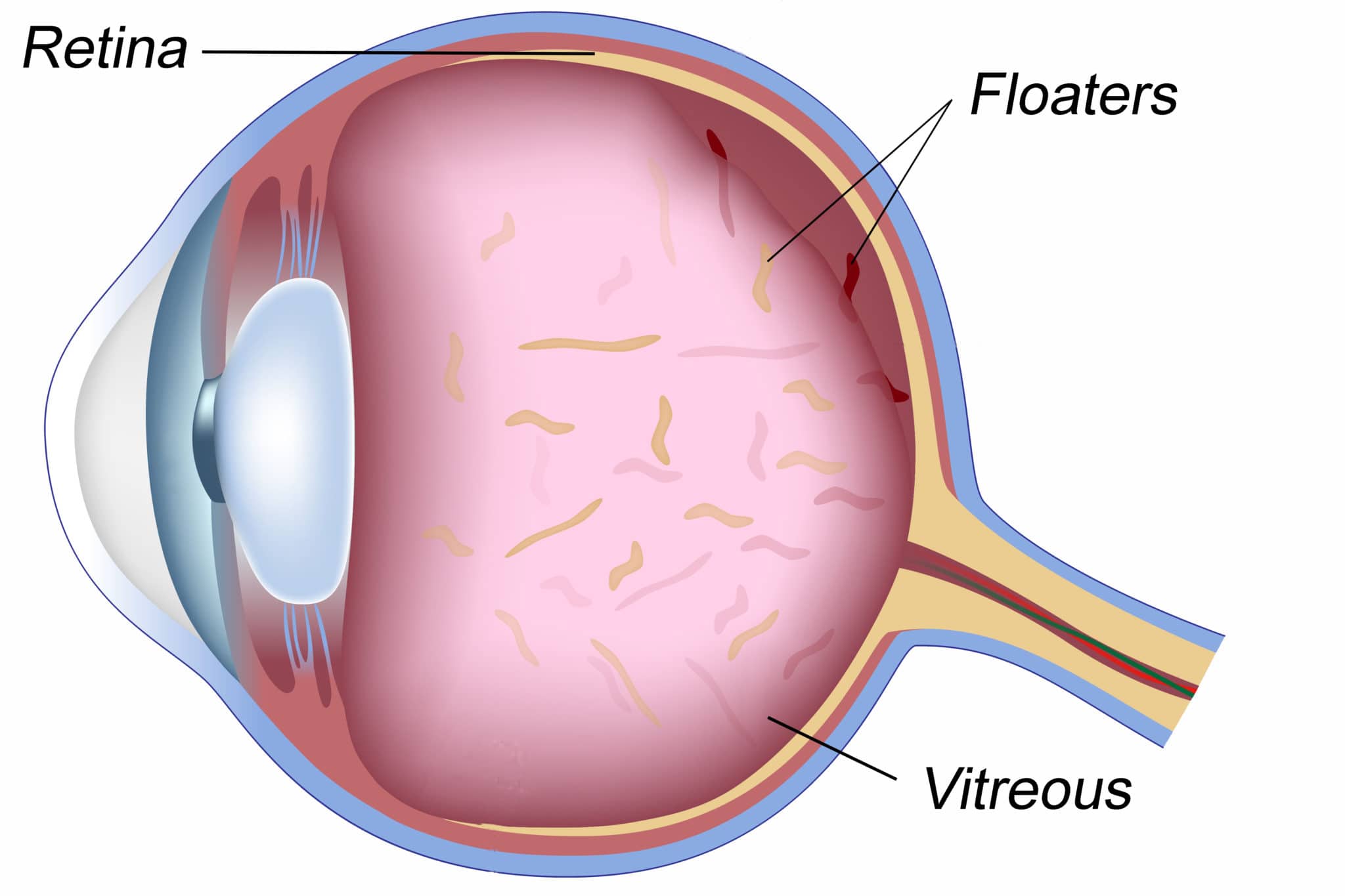 Floaters optical optometrist healthdirect