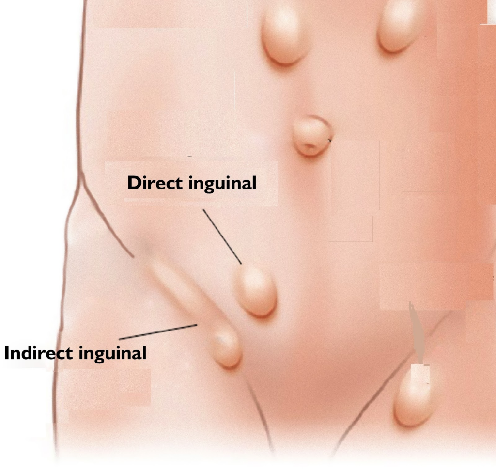 inguinal hernia treatment