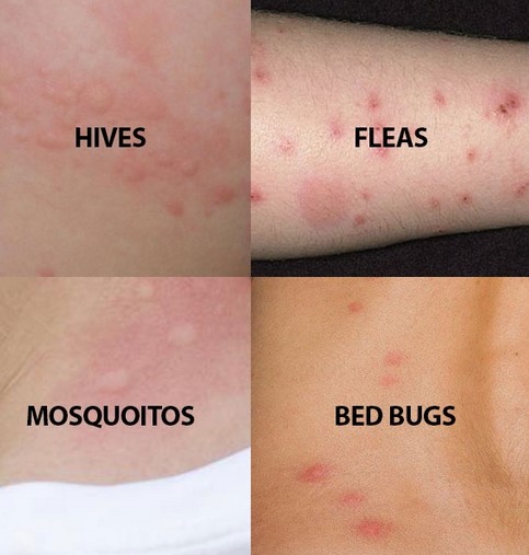 bed-bug-bites-how-to-treat-bed-bug-bites-treatment