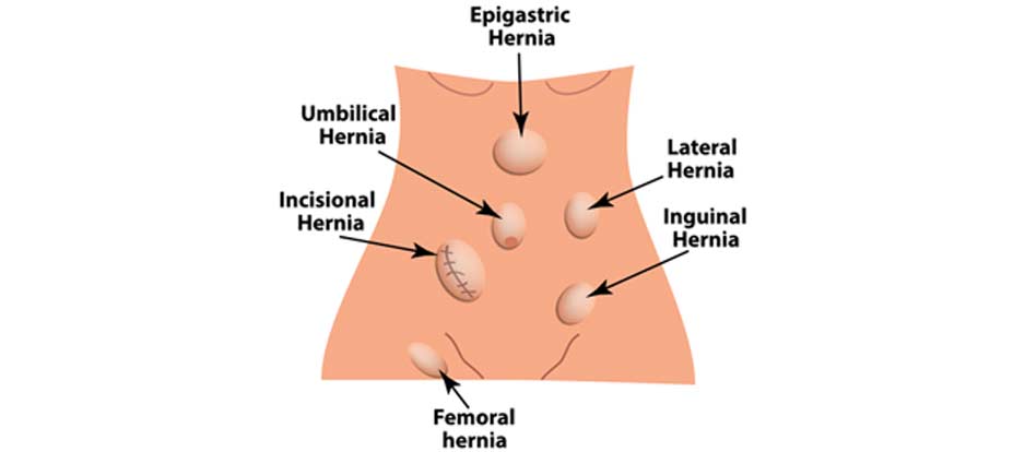 treatment for inguinal hernia