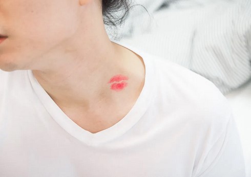 how to get rid of a hickey fast