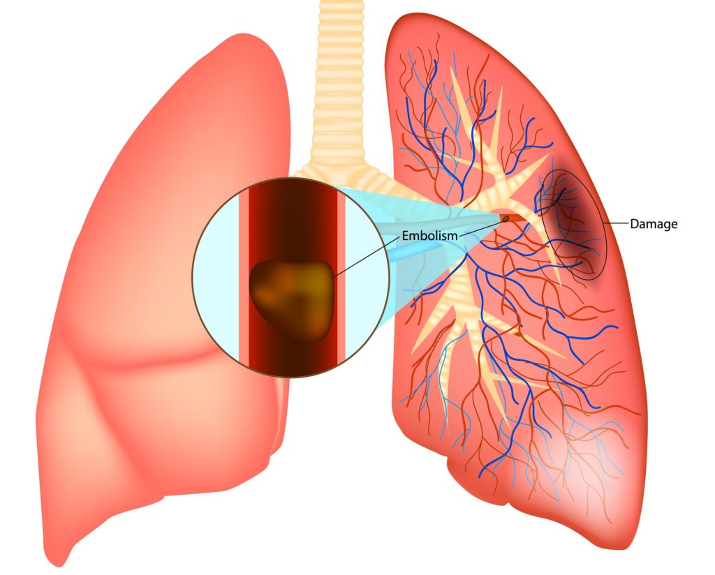 pulmonary embolism