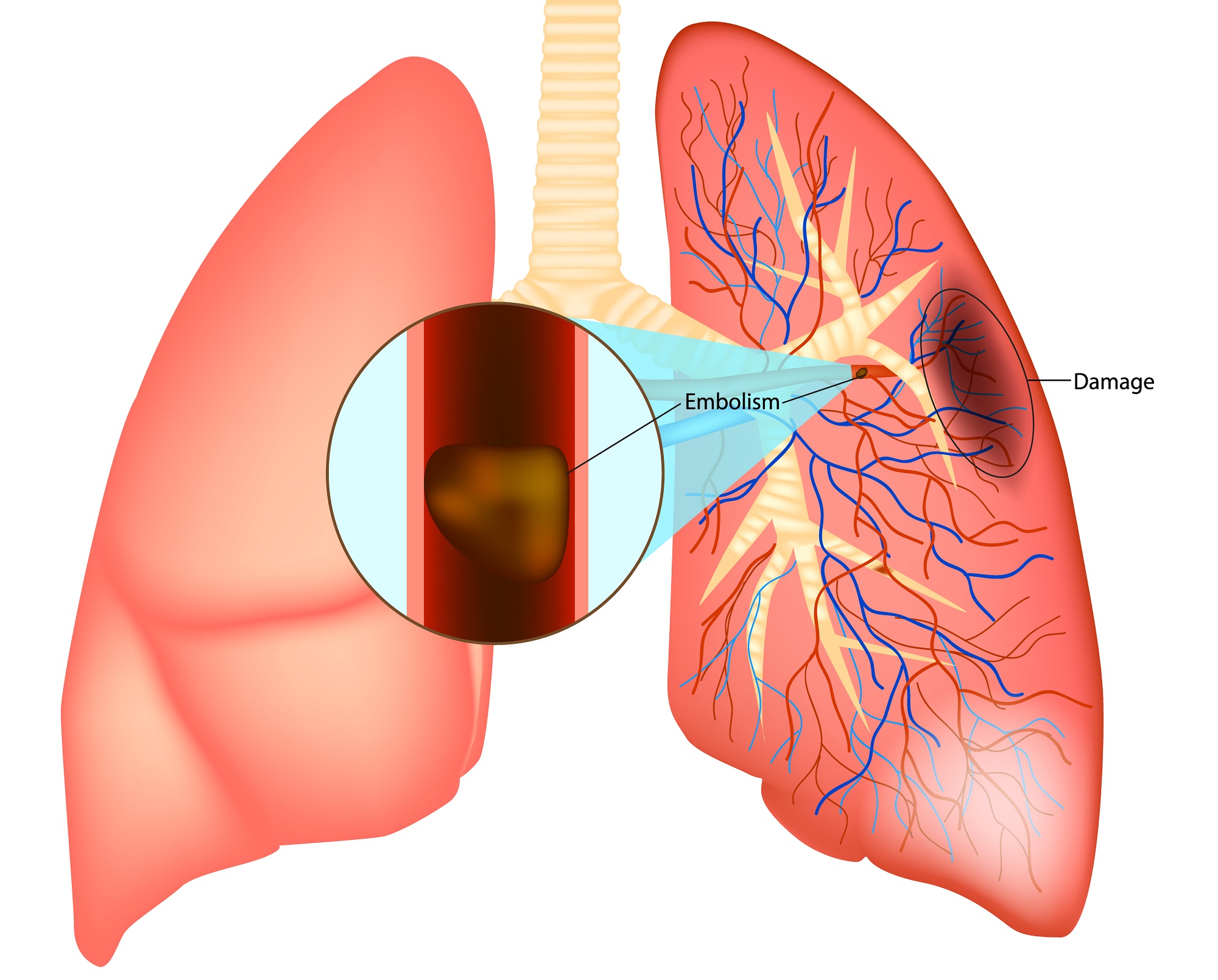Острой тромбоэмболии легочной артерии