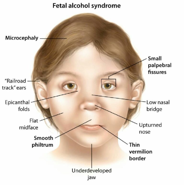 Fetal Alcohol Syndrome Causes, Symptoms And Diagnosis