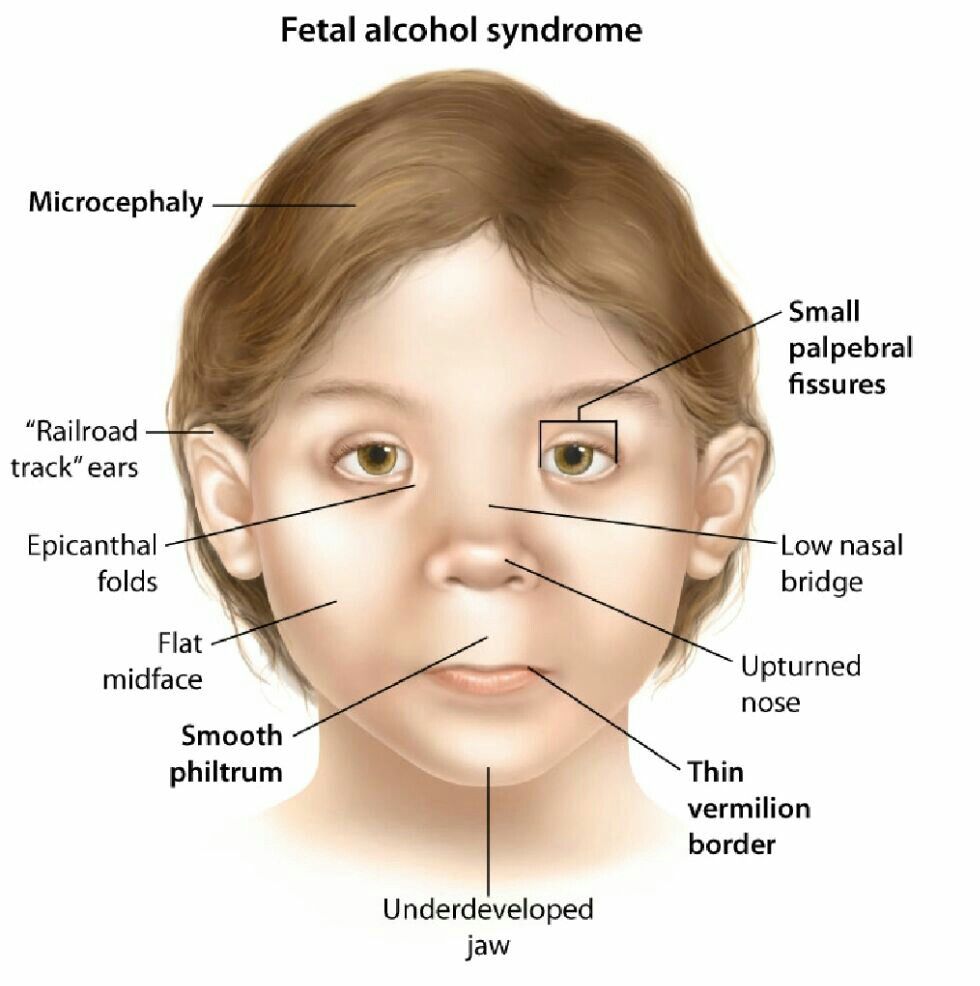 research paper on fetal alcohol syndrome