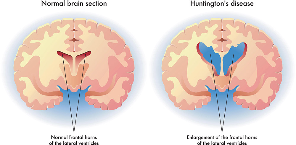 treatment for huntington's disease