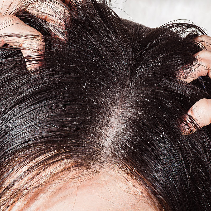 What Causes of Dandruff and Home Remedies | The Kitchensurvival