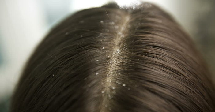 what causes of dandruff