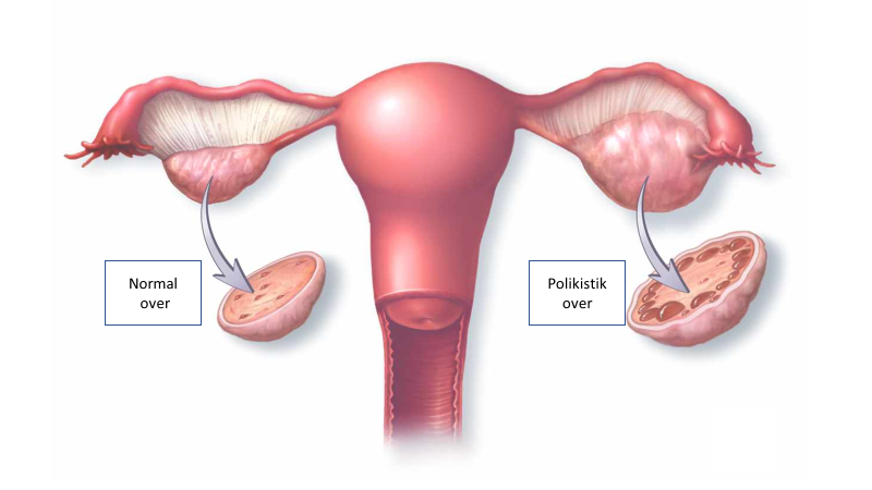 polycystic ovarian syndrome symptoms