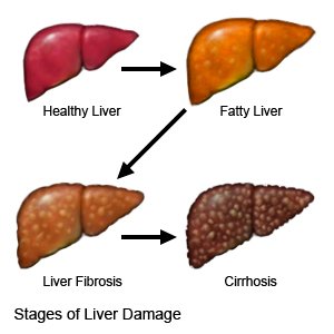 Fatty Liver Causes And Cure